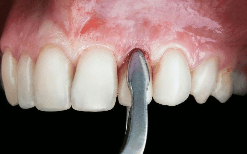Tooth Extraction
